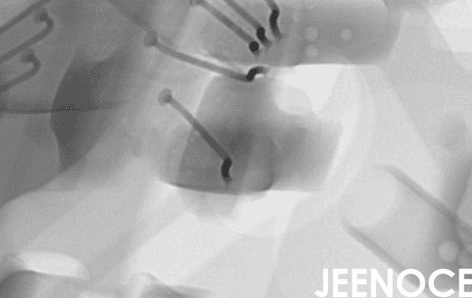 01005微型元器件贴装缺陷查不出？X-Ray选型、数据闭环与质量成本控制(图1)